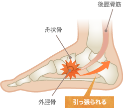 有痛性外脛骨