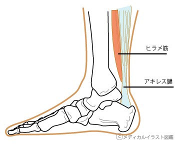 アキレス腱炎