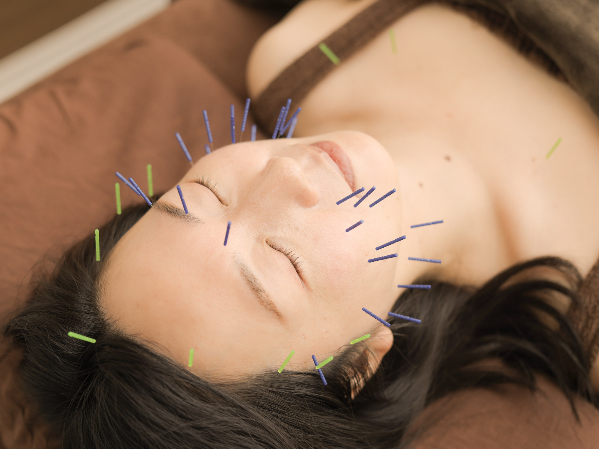 美容鍼灸