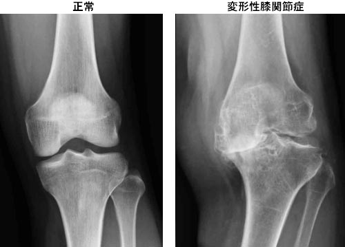 変形性膝関節症