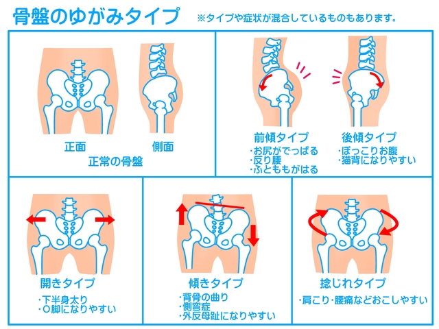 産後の腰痛 骨盤の歪み ブログ 豊中少路で整体 産後骨盤矯正は美療鍼灸整骨院